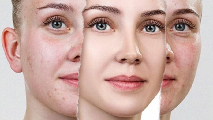 Skin Care Tips: चेहरे पर आये पिम्पल्स के दाग-धब्बे जड़ से होंगे खत्म, अपनाये यह तरीका
